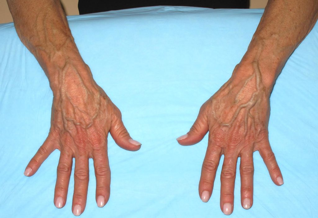 Here S Why Your Blood Is Red But Veins Are Blue Goodfullness As It Turns Out This Is A Question That Much Easier To Answer Than Most Might Realize The Blood Runs Through Our Bos Always Red