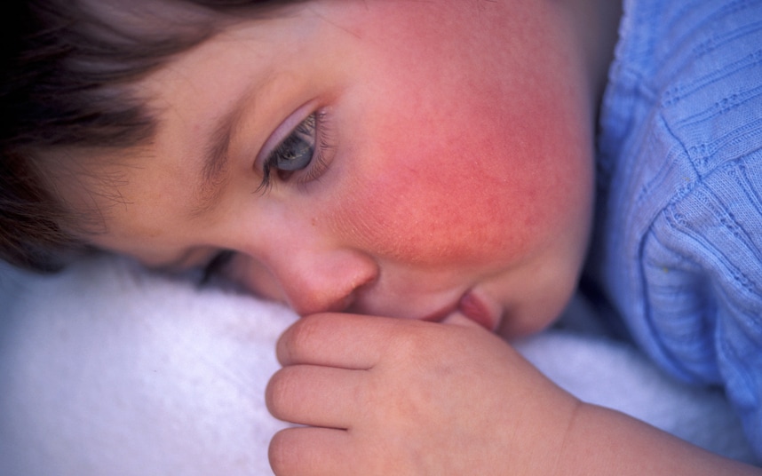 scarlet-fever-rash-on-a-patient-s-arm-photograph-by-science-photo-library