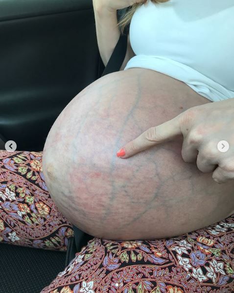 Woman Reveals Just What It's Like To Be Pregnant With ...
